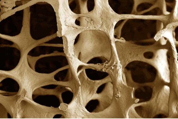 โรคกระดูกพรุน และวิธีรักษา