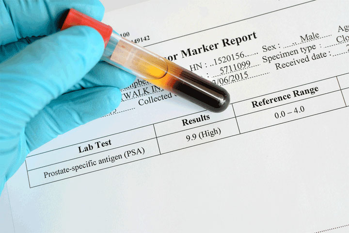 สารบ่งชี้มะเร็ง (tumor markers)