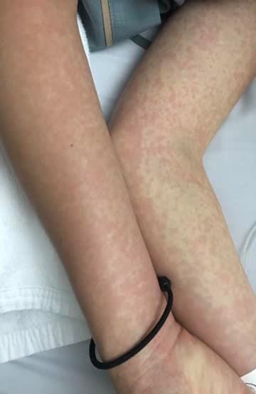 โรคไข้ปวดข้อยุงลายหรือโรค Chikungunya ชิคุนกุนยา