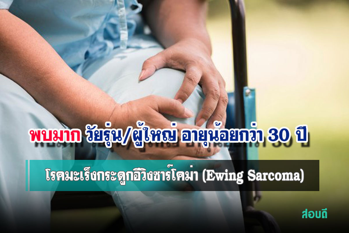 โรคมะเร็งกระดูกอีวิงซาร์โคม่า (Ewing Sarcoma)