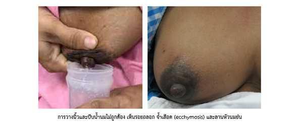 การบีบน้ำนมด้วยมือ