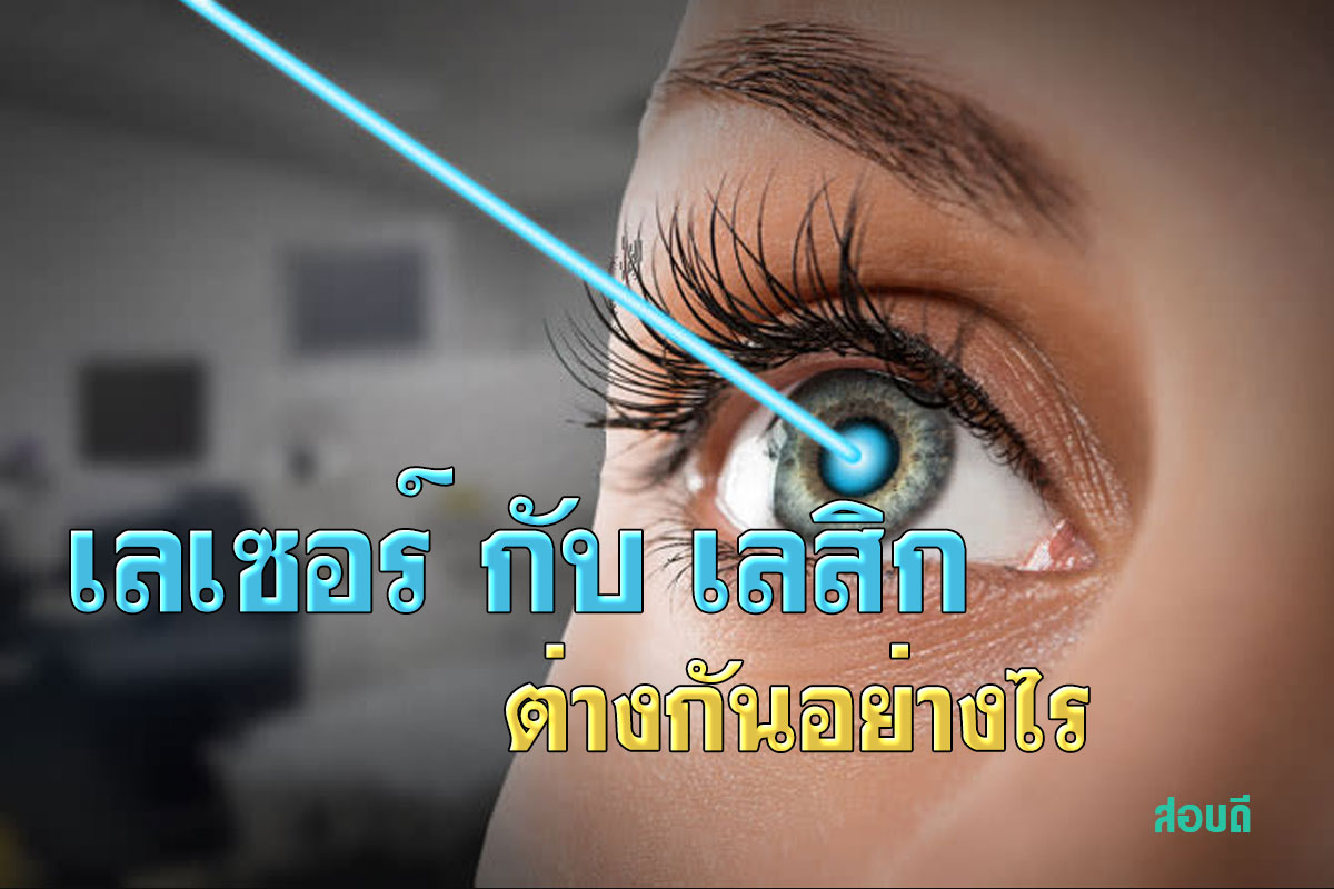 เลเซอร์ กับ เลสิก ต่างกันอย่างไร