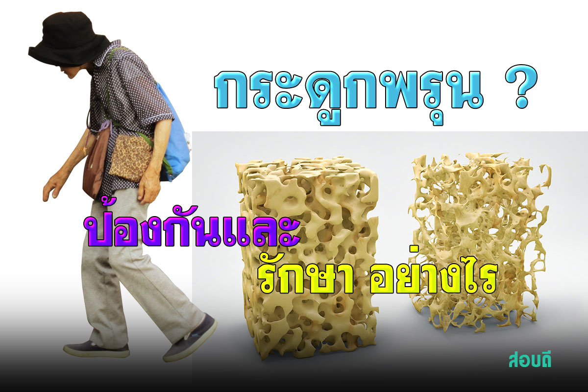 กระดูกพรุน เกิดจากอะไร มีวิธีป้องกันอย่างไร