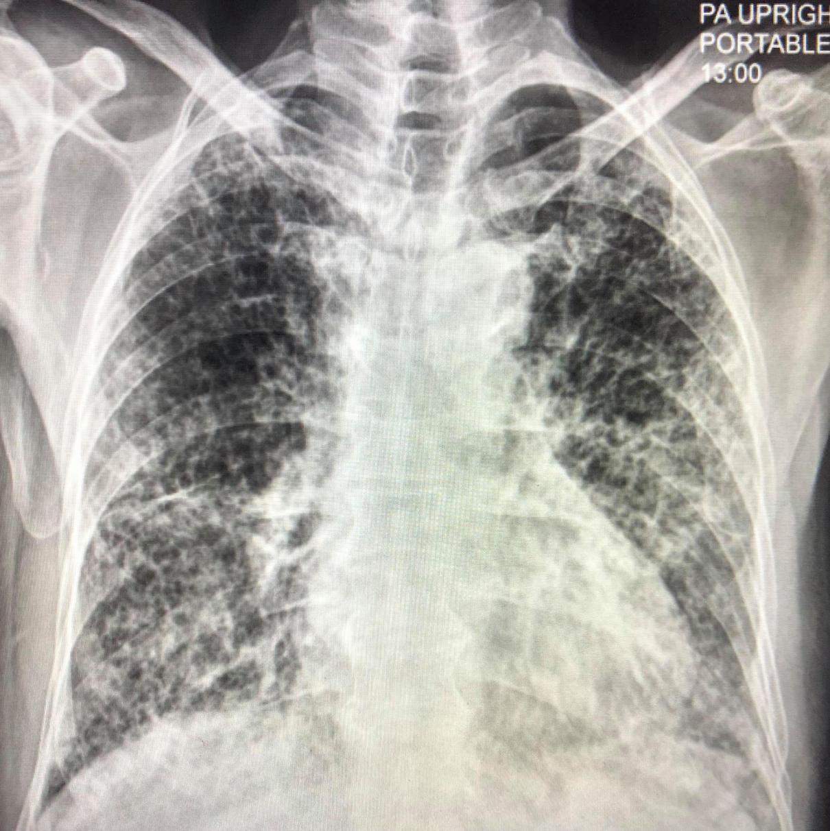 เชื้อไวรัสโควิด-19 สายพันธุ์อัลฟาหรือสายพันธุ์อังกฤษ เล่นงานปอดรุ่นแรง