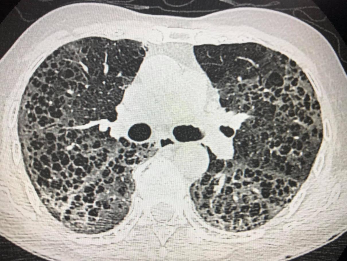 เชื้อไวรัสโควิด-19 สายพันธุ์อัลฟาหรือสายพันธุ์อังกฤษ เล่นงานปอดรุ่นแรง
