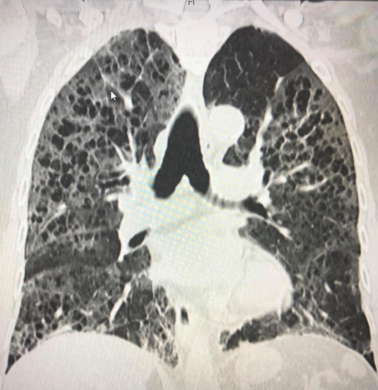 เชื้อไวรัสโควิด-19 สายพันธุ์อัลฟาหรือสายพันธุ์อังกฤษ เล่นงานปอดรุ่นแรง