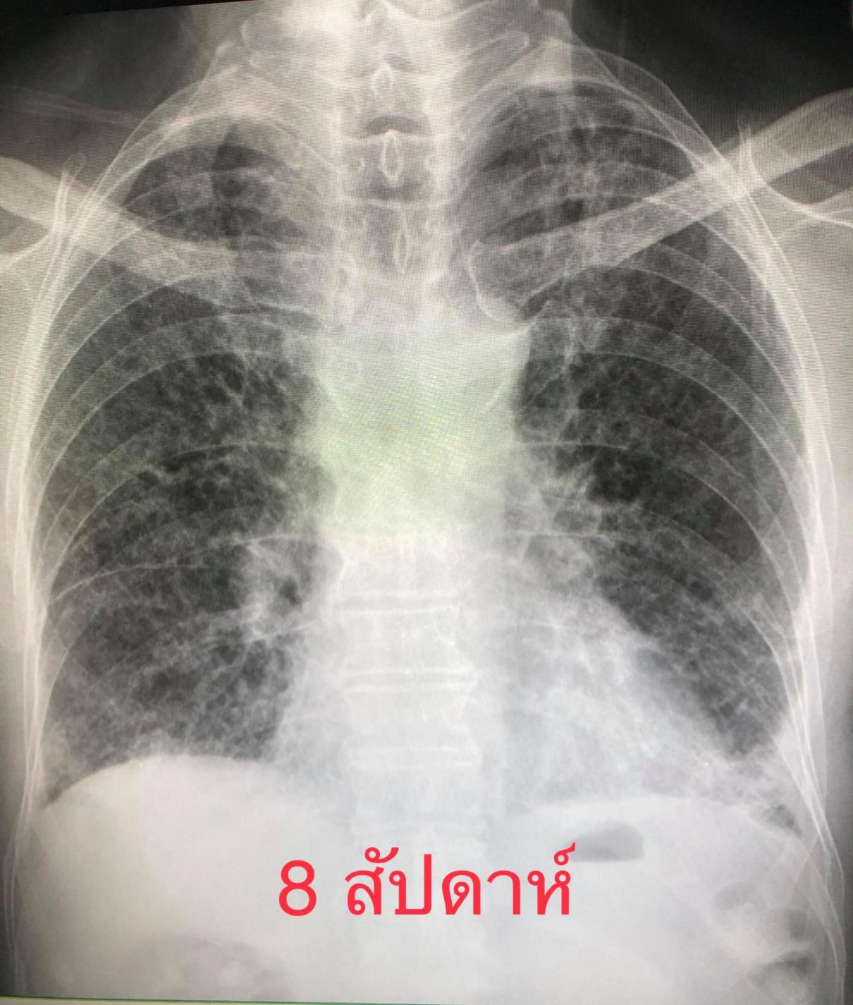 เชื้อไวรัสโควิด-19 สายพันธุ์อัลฟาหรือสายพันธุ์อังกฤษ เล่นงานปอดรุ่นแรง