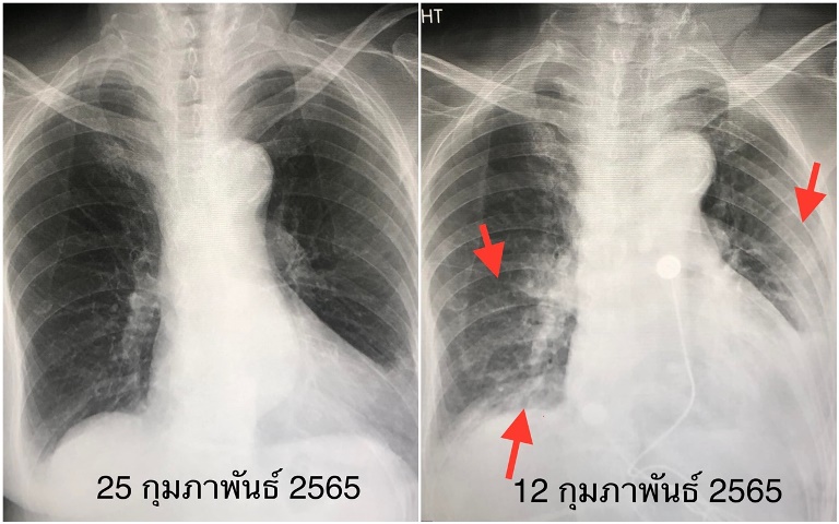 มีโรคประจำตัวเรื้อรัง 7 โรค และหญิงตั้งครรภ์ หากติดเชื้อไวรัสโควิด-19 สายพันธุ์โอมิครอน