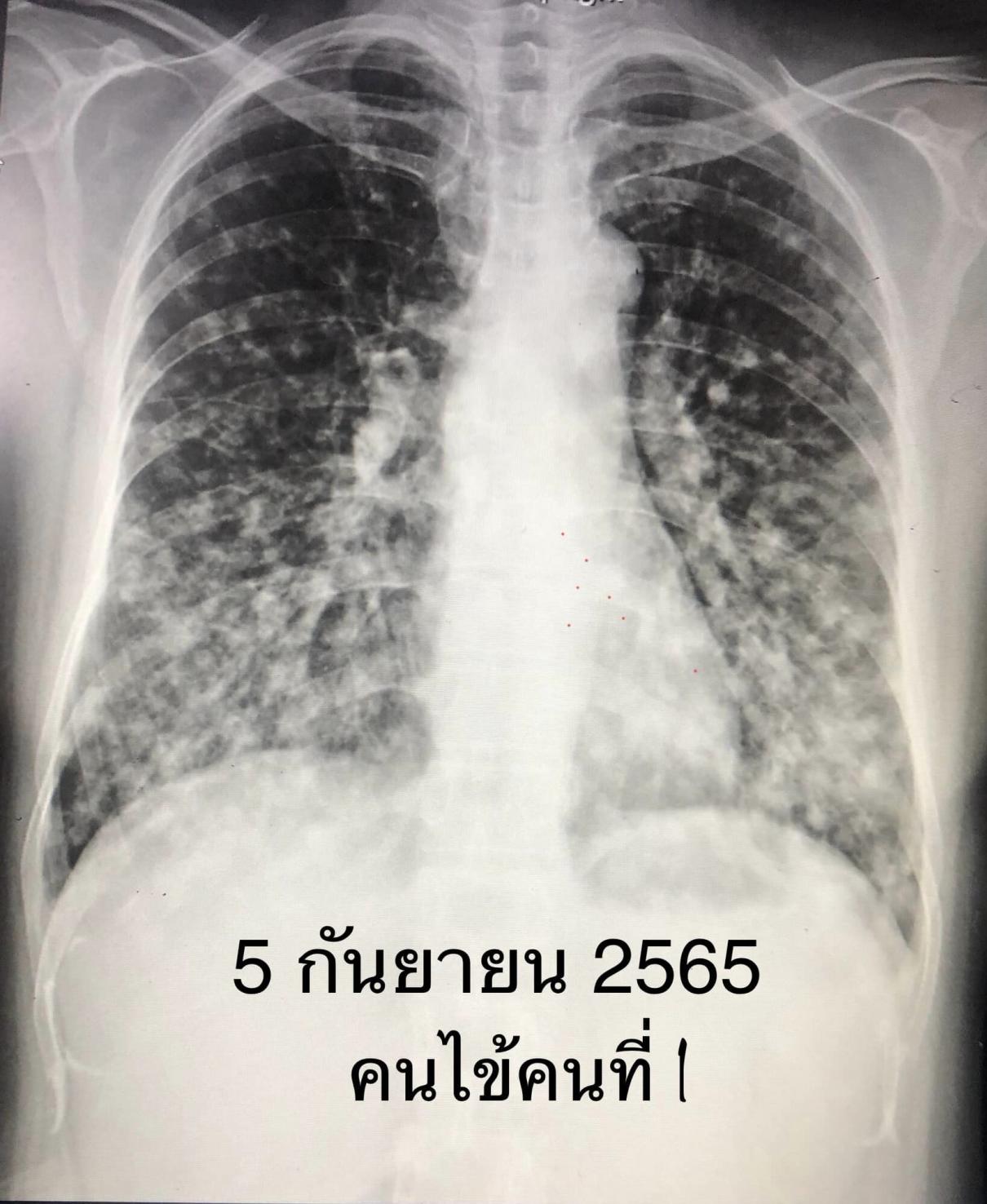 เชื้อราฮิสโตพลาสมา แคปซูลาตุม (Histoplasma capsulatum)