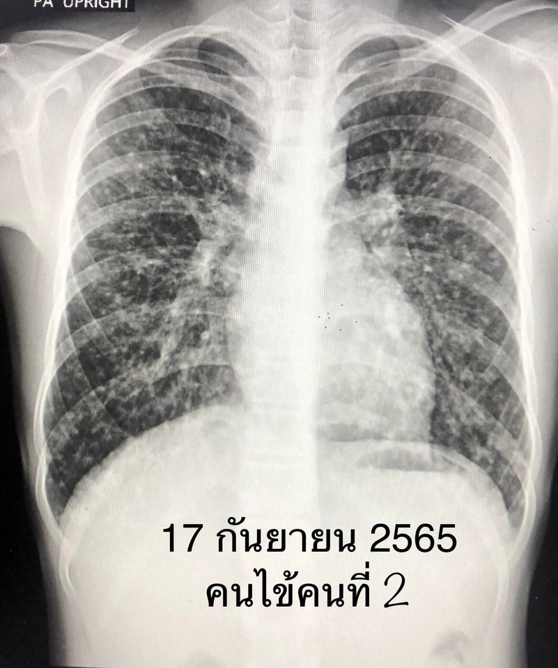 เชื้อราฮิสโตพลาสมา แคปซูลาตุม (Histoplasma capsulatum)